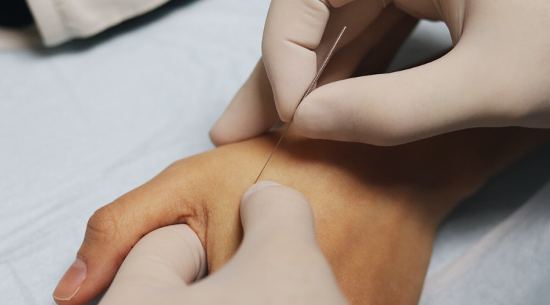 Foto Triggerpunkttherapie und Dry Needling